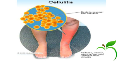 سلولیت (Cellulitis) چیست؟
